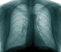 Mesothelioma Lawsuit Results in $1.42M Award