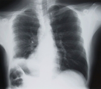 Pennsylvania, West Virginia Residents Seeking Asbestosis Compensation