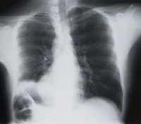 The Litigation and Liability Strategies Behind Asbestosis Lawsuits