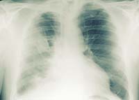 Asbestos Mesothelioma – A Creeping Epidemic