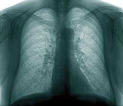 Chest X-Ray