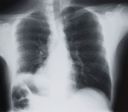 Lawsuit stated company knew about asbestos danger